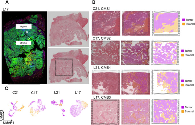 Transcriptome profiles and molecular subtypes of primary and liver metastatic tumors of CRC. (A) Representative image of the spatial transcriptomic analysis, covering some ROIs of the spatial proteomic analysis; scale bar 10 mm; (B) Overview of the spatial transcriptomic sections. H&E staining of spatial transcriptomic sections (left). Identification of the tumor and stromal area of each section (middle). Spatial cluster distribution of each section (right); analysis size 6.5 × 6.5 mm (C) Feature plots showing cluster of tumor and stromal areas of each section