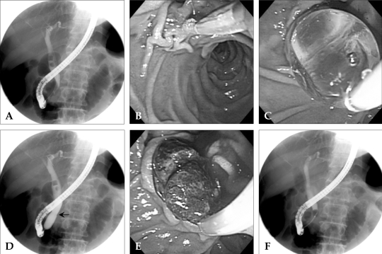 Endoscopic papillary balloon dilation with limited endoscopic sphincterotomy. The endoscopic retrograde cholangiography (ERC) showed two free-floating stones, one of which was measured at 15 mm diameter, (A). A pull-type sphincterotome was inserted into the major papilla, located in the lower margin of the perivater diverticulum, (B). After limited EST, EBD with a balloon catheter of 15 mm diameter was performed, (C). The ERC showed the inflated balloon and its waist by the biliary sphincter had disappeared, black arrow, (D). With a Dormia basket, two stones were retrieved through the dilated orifice of major papilla, (E). ERC after complete stone retrieval revealed no residual filling defect in the bile duct, (F).