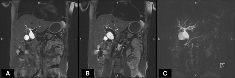 Magnetic resonance cholangiopancreatography (MRCP). MRCP revealed a dilatation from the common hepatic duct to the middle bile duct (a and b) with pancreaticobiliary maljunction (c)