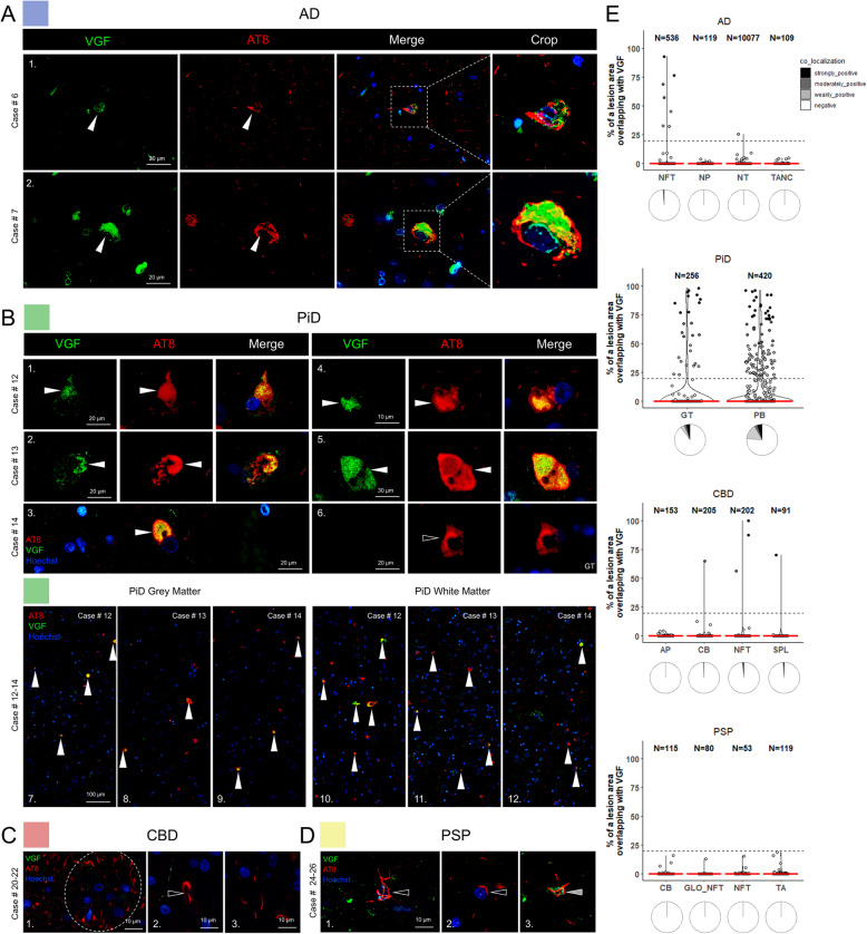 VGF co-localizes with AT8 phospho-tau aggregates in AD and PiD human autopsy cases. A In AD cases, VGF was occasionally sequestered into NFTs (series 1–2). B Neuronal PiD inclusions were co-localized with VGF, which associated within the cores of most PBs, ranging from spherical to horseshoe-shaped (series 1–5). Glial inclusions were mostly found not to be associated with VGF (series 6). 60 × tile imaging demonstrates the association of sequestered VGF to grey matter PBs (series 7–9) and variable white matter glial inclusions (series 10–12). C VGF did not co-localize in APs of CBD (series 1), and most oligodendroglial CBs (series 2), or NT pathology (series 3). D PSP TAs (series 1) and CBs (series 2) did not co-localize with VGF. Very rare instances of partial co-localization below the chosen 20% cut-off overlap were observed in a minority of TAs in one PSP case (series 3). E Quantification of VGF -positive phospho-tau lesions from n = 3 cases/tauopathy showing the relative area of overlap between AT8 and VGF in tauopathy lesions. Modified violin plots with data points show individual lesions plotted against relative overlap area. Lesions are categorized into co-localization categories based on their relative area of overlap. Red lines indicate median values. Pie charts underneath the violin plots illustrate the relative proportions of lesions with different degrees of co-localization. Abbreviations: AD, Alzheimer’s disease; PiD, Pick’s disease; CBD, corticobasal degeneration; PSP, progressive supranuclear palsy; NFTs, neurofibrillary tangles; TANCs, tangle-associated neuritic clusters; APs, astrocytic plaques; CBs, coiled bodies; PBs, Pick bodies; GT, glial tau; NTs, neuropil threads; NP, neuritic plaque; SPL, small phospho-tau lesions; TA, tufted astrocytes; GLO-NFT, globose NFTs