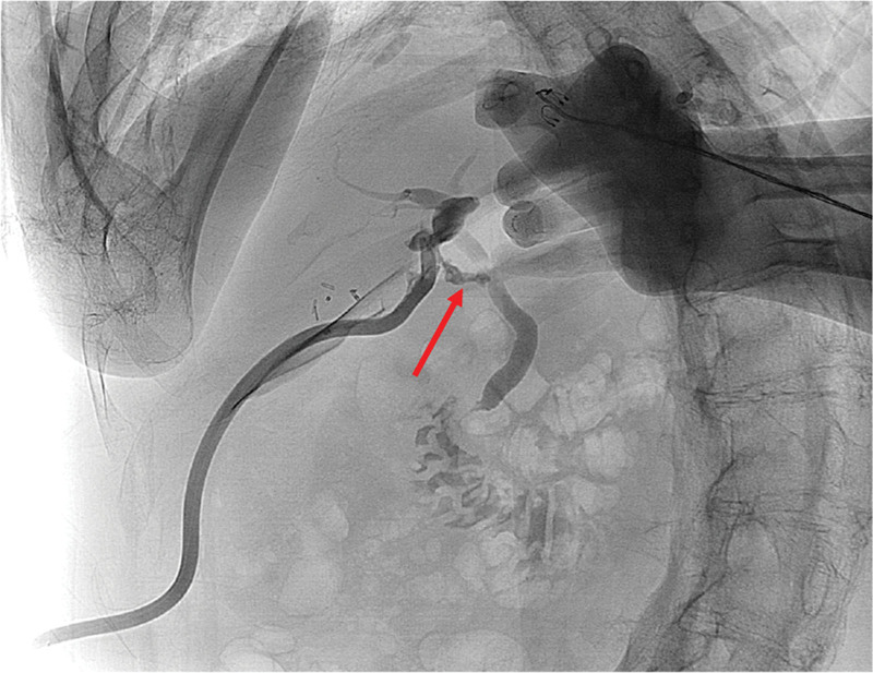 Radiographic view of the surgical drain shows bile leakage at the common bile duct.