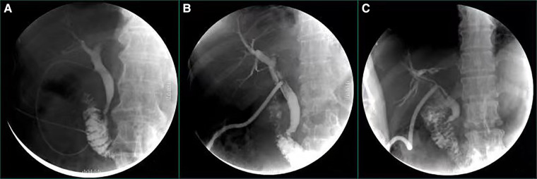 Illustration of postoperative cholangiography, figure (A) illustrates postoperative cholangiography via C-tube; figure (B,C) illustrate postoperative cholangiography via T-tubes.