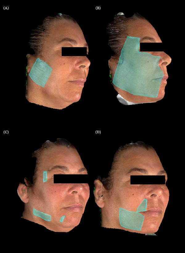 Extraoral somatosensory evaluation with QualST and 3D facial stereophotogrammetry in Case 2. (A) Baseline map of mechanical allodynia; (B) baseline map of pinprick hyperfunction; (C) pinprick hyperfunction at week 4; (D) pinprick hyperfunction at week 8.