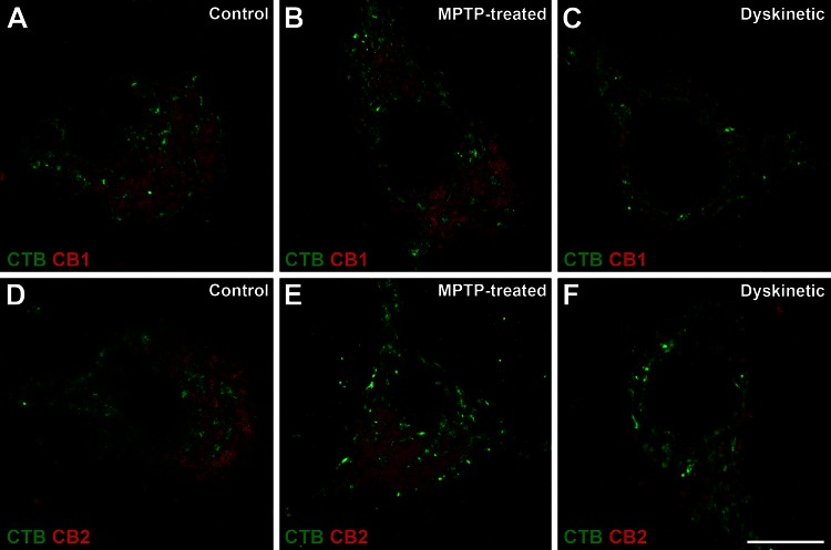 Presence of CB1Rs and CB2Rs in pallidothalamic-projecting neurons of control, parkinsonian and dyskinetic monkeys. A modified version of the PLA technique enabled the visualization of single cannabinoid receptors (red dots) within CTB-labeled pallidothalamic projection neurons (green marker). Panels a–c show CB1Rs in pallidal efferent neurons of control (a), MPTP-treated (b) and dyskinetic (c) monkeys. Panels d, e illustrate CB2Rs in pallidal efferent neurons of control (d), MPTP treated (e) and dyskinetic (f) monkeys. The number of both types of receptors was clearly reduced in the dyskinetic state. Scale bar is 10 μm in all panels