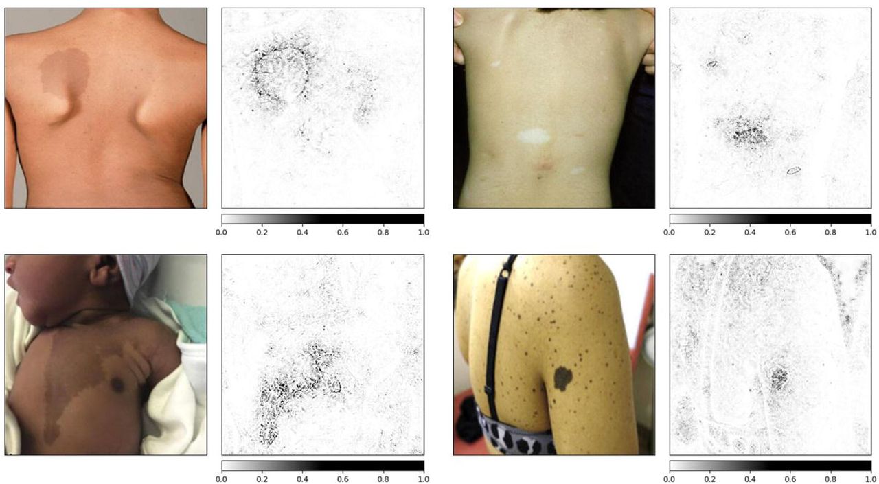 Attribution images, showing which pixels the classifier weights when “deciding” how to categorize. As shown, the classifier uses pixels involved in the skin finding, but may also use other pixels as well. Our research team examined these attribution methods during stages of classifier training and testing in order to determine how to improve performance, such as by incorporating other datasets for training, or when adjusting the neural network hyperparameters. Clockwise, from top left: Neurofibromatosis type 1 (NF1); Tuberous Sclerosis Complex (TSC); Noonan syndrome with Multiple Lentigines (ML); McCune-Albright syndrome (MA). Image sources (all used with appropriate permissions; see Supplemental data for permissions):NF1: https://pubmed.ncbi.nlm.nih.gov/24432075/#&gid=article-figures&pid=fig-2-uid-1TSC: https://pubmed.ncbi.nlm.nih.gov/24143074/#&gid=article-figures&pid=figure-3-uid-2ML: https://ars.els-cdn.com/content/image/1-s2.0-S000293431930347X-gr1_lrg.jpgMA: https://www.sciencedirect.com/science/article/pii/S235251261930044X?via%3Dihub#fig1