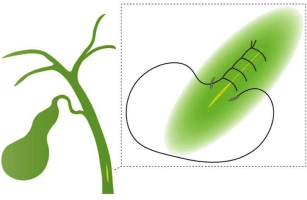 Schematic illustration of PDC in our centre: The common bile duct is closed using a continuous overand-over locking approach. The distance between each needle is approximately 2mm, and the entry and exit points are approximately 1mm from the incisal edge of the common bile duct.