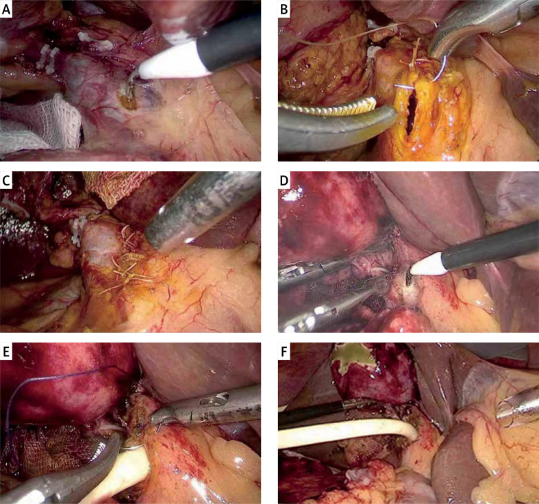 Representative images of T-tube drainage and primary closure. A–C – representative images of primary closure. A – Free anterior wall of the common bile duct before opening, B – primary closure of the common bile duct after LCBDE, C – completed primary suture of the common bile duct. D, E – representative images for T-tube drainage. D – The free anterior wall of the common bile duct before opening, E – insertion of the T-tube and interrupted suture after LCBDE. F – The common bile duct sutured after insertion of the T-tube