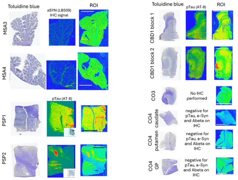Representative ROIs selected in tissue sections from patients with multiple-system atrophy (MSA), corticobasal degeneration (CBD), progressive supranuclear palsy (PSP), and non-dementia controls (CO) on which analysis was done for Figure 5 and Table A8. ROIs were delineated based on toluidine blue staining for anatomical reference.