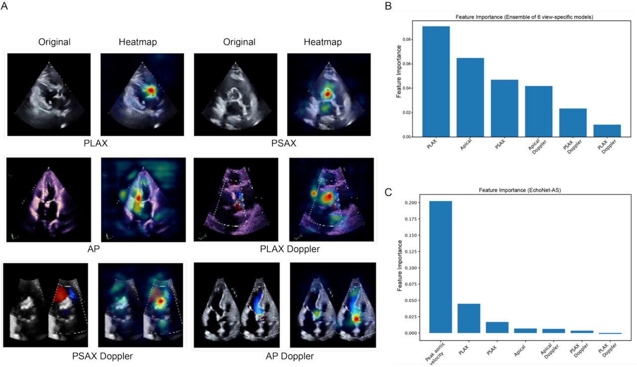 Model interpretability and feature importance analysis. A. Representative Smooth Grad visualizations for each of the six echocardiographic views (parasternal long axis [PLAX], parasternal short axis [PSAX], apical [AP], and their corresponding Doppler views) illustrating regions contributing most to model predictions of aortic stenosis (AS) severity. B, C. Model-level feature importance from the ensemble classifier. B shows feature importance for the ensemble of view-specific models. C shows feature importance when peak aortic velocity is included as an additional input feature.