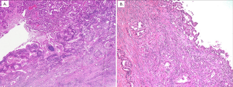 Histopathological findings of the two primary malignanciesA: Histopathological examination of the pancreatic lesion revealed moderately differentiated tubular adenocarcinoma confined to the pancreatic head, without involvement of the extra-pancreatic bile duct. Adenocarcinoma in situ (AIS) was observed extending from the ampullary epithelium into the common channel and main pancreatic duct, consistent with pancreatic head adenocarcinoma.B: Histopathological examination of the hepatic lesion demonstrated AIS arising from the intrahepatic bile duct epithelium with associated stromal invasion, consistent with intrahepatic cholangiocarcinoma. No histologic continuity between the pancreatic and hepatic tumors was identified, supporting the diagnosis of metachronous double primary cancers.