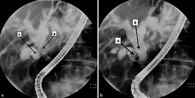 a Dilated cystic duct (A) and dilated CBD (B), proximal to the obstructing stone in the cystic duct during cholangiography. b A stone in the cystic duct (A) which moved slightly with catheter use during ERCP, causing relief of obstruction in the CBD (B). The picture shows a dilated CBD (B).