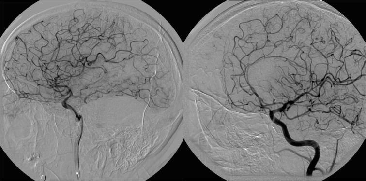 Cerebral angiography: multiple caliber changes in the intracranial vessels