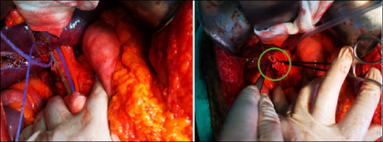 Identification of the common bile duct and the proximal duct after transection.
