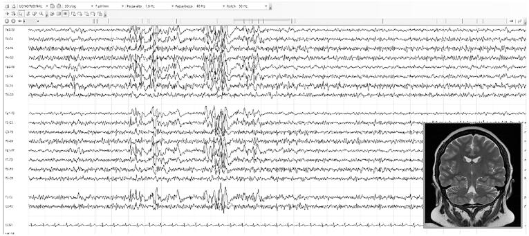 Patients’ EEG (longitudinal, 30 sec/page, 7 μV/mm) and brain MRI (high‐resolution 2D T2 image). Notice the abundant generalized high-voltage sharp-waves predominant in the anterior regions in particular in the right hemisphere. Background activity shows theta rhythm (7–8 Hz) with a good reaction to eyes’ opening.