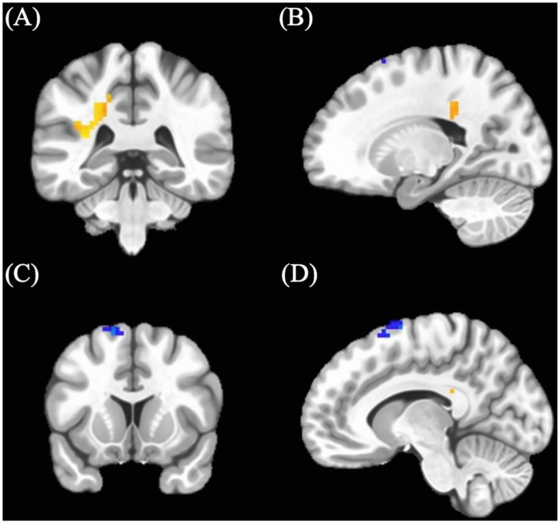 Significant positive n> neutral Go BOLD clusters between cannabis-using and non-using participants. (A) Coronal and (B) sagittal view of left middle cingulum cluster demonstrating increased activation amongst cannabis-using participants. (C) Coronal and (D) sagittal view of left supplemental motor cluster demonstrating decreased activation amongst cannabis-using participants.