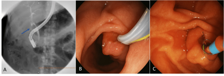 ERCP findings confirming gallbladder agenesis and choledocholithiasis.(A) Cholangiographic image showing the absence of the gallbladder. The blue arrow indicates a 20 × 20 mm filling defect in the supraduodenal portion of the common bile duct, consistent with choledocholithiasis.(B) Endoscopic view of the ERCP probe at the level of the duodenal papilla.(C) Extended sphincterotomy and placement of a 10 Fr × 9 cm plastic biliary stent.ERCP: endoscopic retrograde cholangiopancreatography.