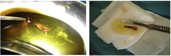 A case of conventional cholecystectomy (A) Fasciola worm swims in the bile in vitro (B) Fasciola worm in vitro.
