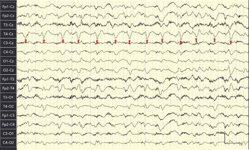EEG of the patient.