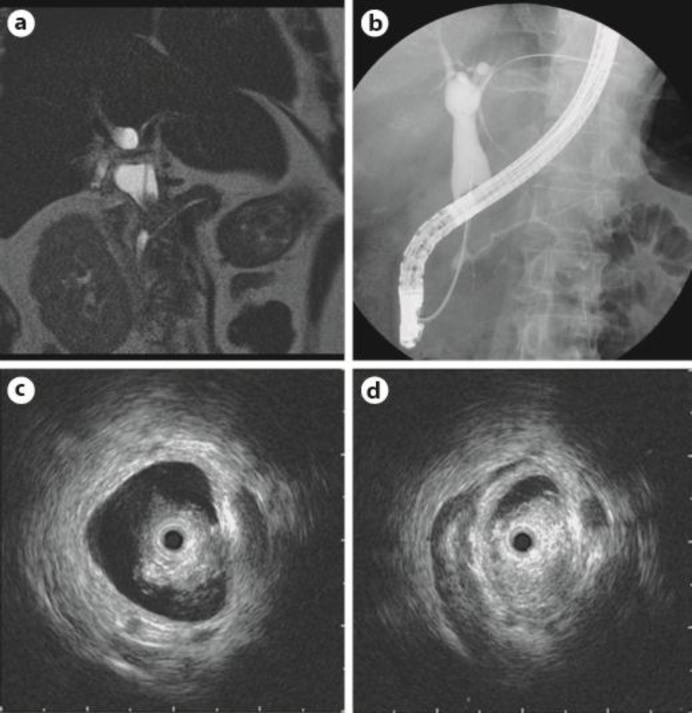 a, b PBM was identified by MRCP (a) and ERCP (b). c, d Intraductal ultrasonography showed that the nodule was papillary.