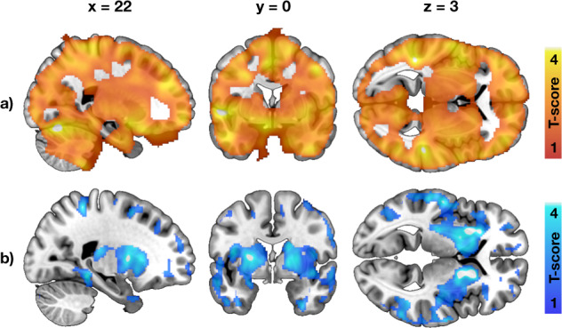 Effects of familial obesity risk to central glucose uptake and μ-opioid receptor availability.a Brain regions where higher Family Risk score associated with increased brain glucose uptake in the 38 individuals studied with [18F]FDG. b Brain regions where higher Family Risk score associated with lower μ-opioid receptor availability in the 41 individuals studied with [11C]carfentanil. The effects of familial obesity risk we global for brain glucose uptake, whereas the associations were most prominent in striatum and insula for μ-opioid receptors. The images show results from SnPM13 linear regression, with age and other risk factors (BMI, physical exercise) as covariates. The data are thresholded at p < 0.05, FWE corrected at cluster level.