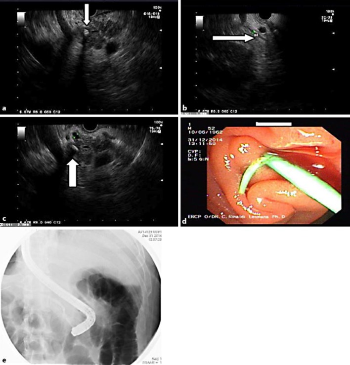 a EUS image showing suspicion of a pancreatic stone with the differential diagnosis of calcification. b EUS image showing the normal pancreatic duct. c EUS image showing a possible cyst with a stone inside. d Endoscopy image showing that the pancreatic stent was inserted into the pancreatic duct. e Fluoroscopy image during ERCP procedure showing the pancreatogram.