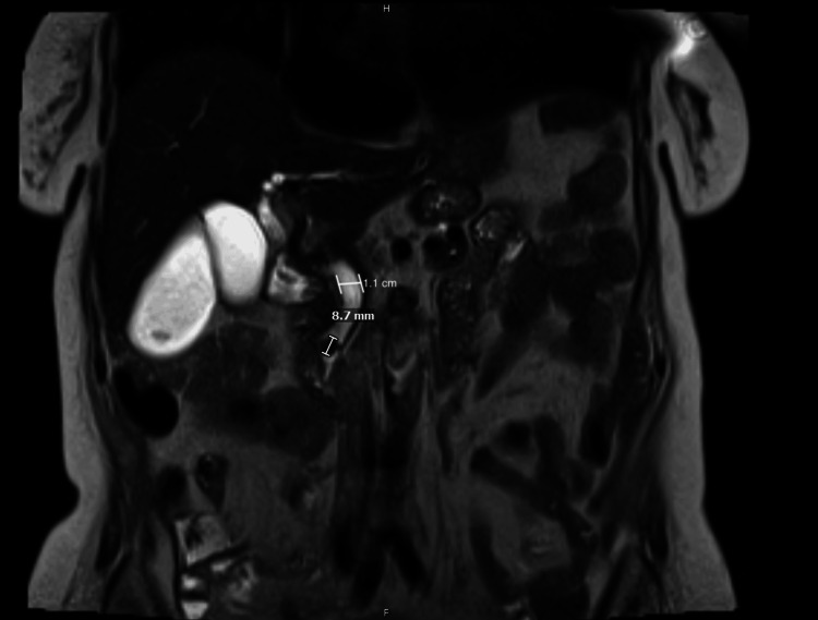 T2-weighted MRCP showing dilation of the intrahepatic and extrahepatic biliary system, with the common bile duct measuring 1.1 cm, and evidence of a distal CBD obstructing stone measuring 8.7 mmMRCP: magnetic resonance cholangiopancreatography; CBD: common bile duct