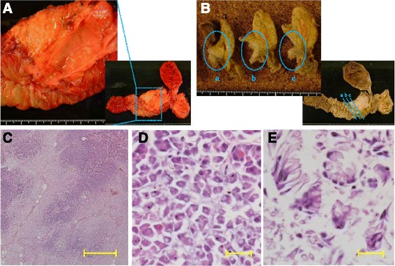 a Resected specimen. Macroscopically, there is an exposed protruded tumor (interrupted square). b The cut surface of the duodenal wall and the pancreatic head (a most anal; c most oral). From a to c, there are whitish tumors (interrupted circles). The scale divisions represent 1 mm each in a and b. c Histopathologically, the cancer cells show the pancreatic invasion with infiltrative growth and fibrosis. The most parts of the tumor are poorly differentiated adenocarcinoma, and the ratio of signet-ring cells was about 10–15% (hematoxylin-eosin, ×40, the scale bars indicate 1 mm). d, e Tumor cells contain mucin, which makes the nucleoli crescent-shaped (hematoxylin-eosin, ×600, the scale bars indicate 20 μm)