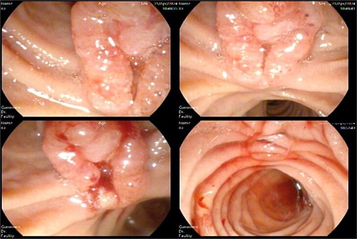 Side view endoscopy showed an ulcerated ampullary mass.