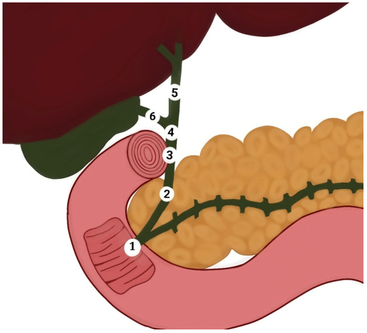 Diagram of the extrahepatic bile duct shows (1) ampulla of Vater, (2) retro pancreatic part of the common bile duct, (3) retro duodenal part of the common bile duct, (4) supraduodenal part of the common bile duct, (5) common hepatic duct, and (6) cystic duct.