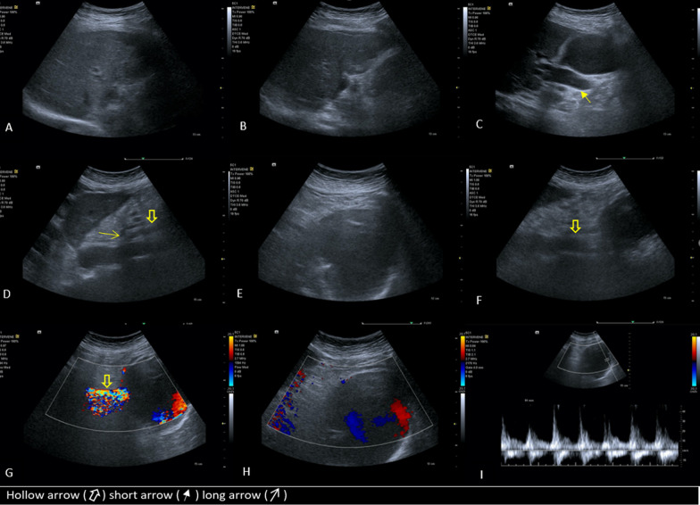 Surface of the liver is irregular and its echogenicity is mildly coarse and heterogeneous. Mild ascites is seen around the liver (A, B). Common bile duct and intrahepatic bile duct dilation (C). Sagittal scan of aorta shows stenosis of proximal of celiac trunk (D). The huge aneurysm with “yin and yang” sign on color Doppler ultrasound, and turbulent arterial blood flow on Spectral Doppler (E, H, I). The aneurysm is superiorly connected to superior mesenteric artery. The superior mesenteric artery continues its course on the anterior surface of the aneurysm to supply the small bowel (F, G). Hollow arrows shows superior mesenteric artery, short arrow shows dilated common bile duct, and long arrow shows celiac trunk