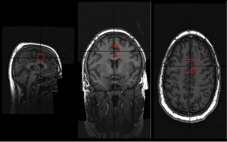MRI brain scan showing three views: sagittal, coronal, and axial. Each view has a red box highlighting a specific area, likely for detailed examination. Brain structures are visible in grayscale.