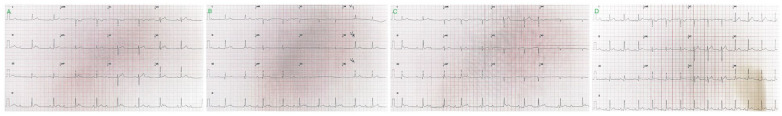 The patient’s 12-lead ECGs. (A) A standard ECG demonstrating 3 mm STE in leads II, III, and aVF and complete heart block at 46 beats/minute. (B) A posterior ECG demonstrating very subtle STE in leads II, III, and aVF and near negligible in V7, V8, and V9, with ongoing complete heart block. (C) A right-sided ECG demonstrating subtle ST-segment depression with T-wave inversion in V3R, V4R. (D) A post-PPCI ECG demonstrating sinus rhythm with resolved STE and subtle, nonspecific ST-T changes. ECGs, electrocardiograms; PPCI, primary percutaneous coronary intervention; STE, ST-segment-elevation.