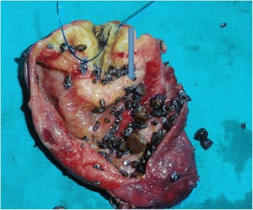 Postoperative specimen with an arrow pointing at the thickening of the gall bladder wall at the fundus