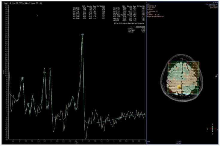 Representative 1H-MRS spectrum acquired from the motor cortex of PD patient by Achieva Philips Medical System software. Left: measured spectrum (green line) with labeled metabolite peaks, including N-acetyl aspartate, creatine, choline, myo-inositol, and glutamate/glutamine. The yellow line represents the difference between the measured signal and the model fit. Right: voxel selected for analysis (yellow box) overlaid on the anatomical brain image, with the spectroscopic grid (green) and tissue segmentation maps (colors) used to guide placement. Reprinted with permission from ref. [36]. Copyright 2022 by the authors. Licensee MDPI, Basel, Switzerland. This article is an open access article distributed under the terms and conditions of the Creative Commons Attribution (CC BY) license (https://creativecommons.org/licenses/by/4.0/, accessed on 15 September 2025).
