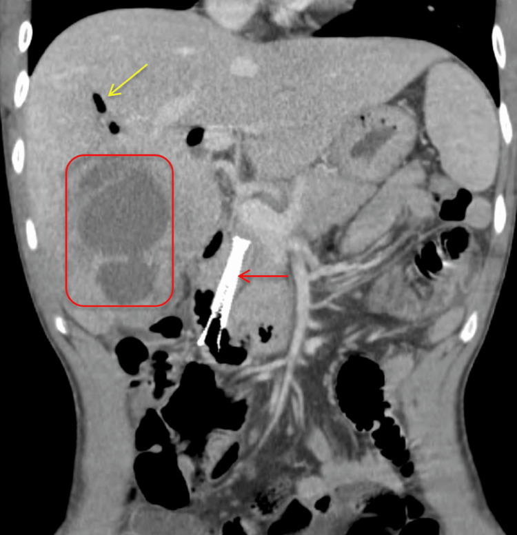 CT abdomen and pelvis with IV contrast (coronal view) demonstrating a peripheral enhancing fluid collection in the right hepatic lobe (red rectangle).Mildly distended intrahepatic biliary ducts are visible with air visible in the biliary tree (yellow arrow), likely related to the common bile duct stent extending into the duodenum (red arrow).