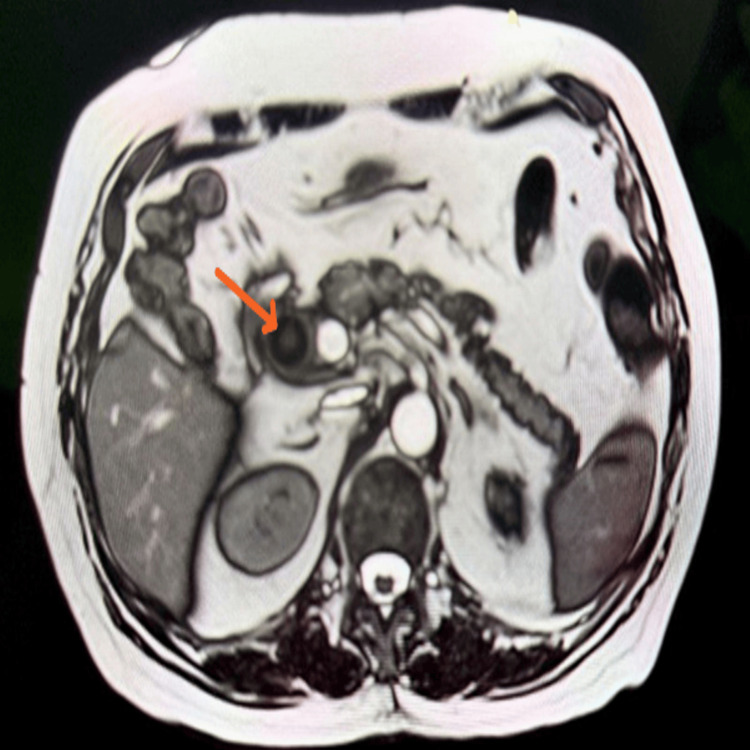 Axial T2-weighted MRI image showing an intraductal filling defect in the region of the mid common bile duct (CBD), suggestive of an intraductal calculus
