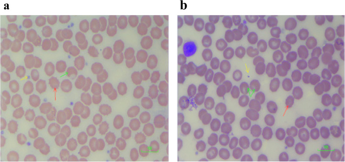 a Blood film of cells exposed to 50 ng/ml cannabidiol (CBD). Blood film showing red cell changes in 50 ng/ml CBD: burr cell formation (echinocytes). Scale = 100 μm (red arrow indicates burr cells; green arrow indicates blister cells, while the yellow arrow indicates extruded cytoplasm). b Blood film of cells exposed to 50 ng/ml delta-9-tetrahydrocannabinol (THC). Blood film showing red cell changes in 50 ng/ml THC: target cell formation, burr cells. Scale = 100 μm (red arrow indicates burr cells; green arrow indicates blister cells, while the yellow arrow indicates extruded cytoplasm)