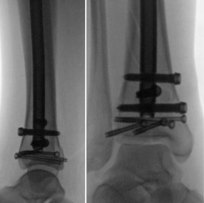 Image showing percutaneous screw fixation of distal tibia followed by suprapatellar intramedullary nail.