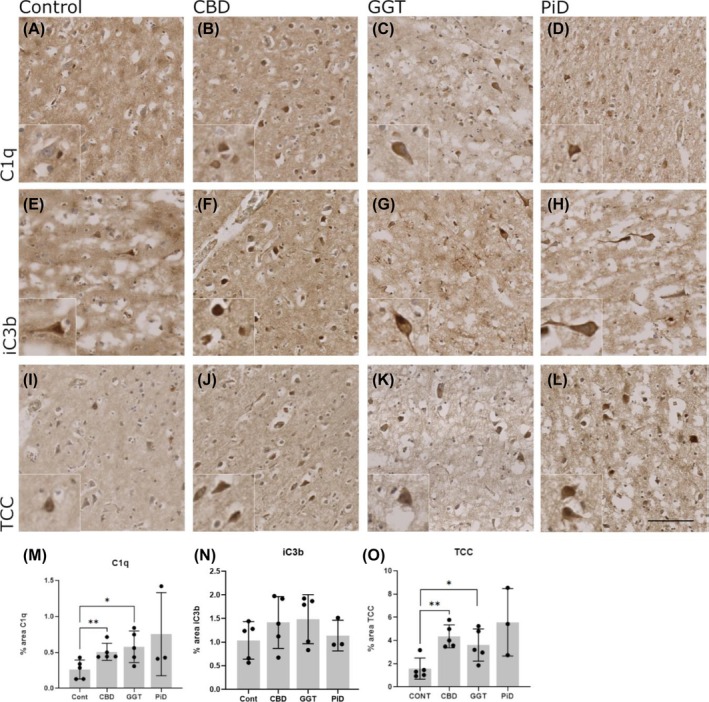 Immunohistochemical analysis of complement levels in non‐demented control and tauopathy cases. (A)–(D), C1q staining on neurons (inset) in control, CBD, GGT, and PiD cases. (M) Quantification of percentage area of C1q immunoreactivity showed a significant increase in CBD (p = 0.0079) and GGT (p = 0.0317) compared to controls. (E)–(H), C3b/iC3b staining on neurons (inset) in control, CBD, GGT, and PiD. (N) Quantification of percentage area C3b/iC3b immunoreactivity did not show any significant difference in C3b/iC3b levels in disease states compared to controls. (I)–(L), TCC staining on neurons (inset) in control, CBD, GGT, and PiD. O, quantification of percentage area TCC immunoreactivity showed significant elevation in CBD compared to controls (p = 0.0079) and GGT compared to controls (p = 0.032). Control, n = 5; CBD, n = 5; GGT, n = 5; and PiD, n = 3. Error bars = mean ± SD. Scale bar = 100 μm.