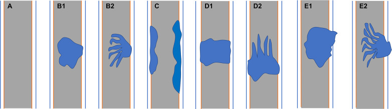 (A) Normal bile duct. Bile duct adenoma presents as focal eccentric-type mass (B1, B2), plaque-like mass (C), bile duct casting mass (D1, D2), and infiltrative mass (E1, E2). Frond-like superficial appearance on focal eccentric-type mass (B2), bile duct casting mass (D2), and infiltrative mass (E2).