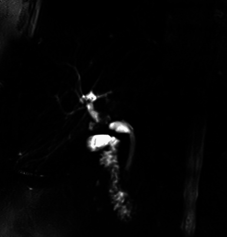 Magnetic resonance cholangiopancreatography (MRCP) showing duct-to-duct stricture and dilatation of the cystic duct stump