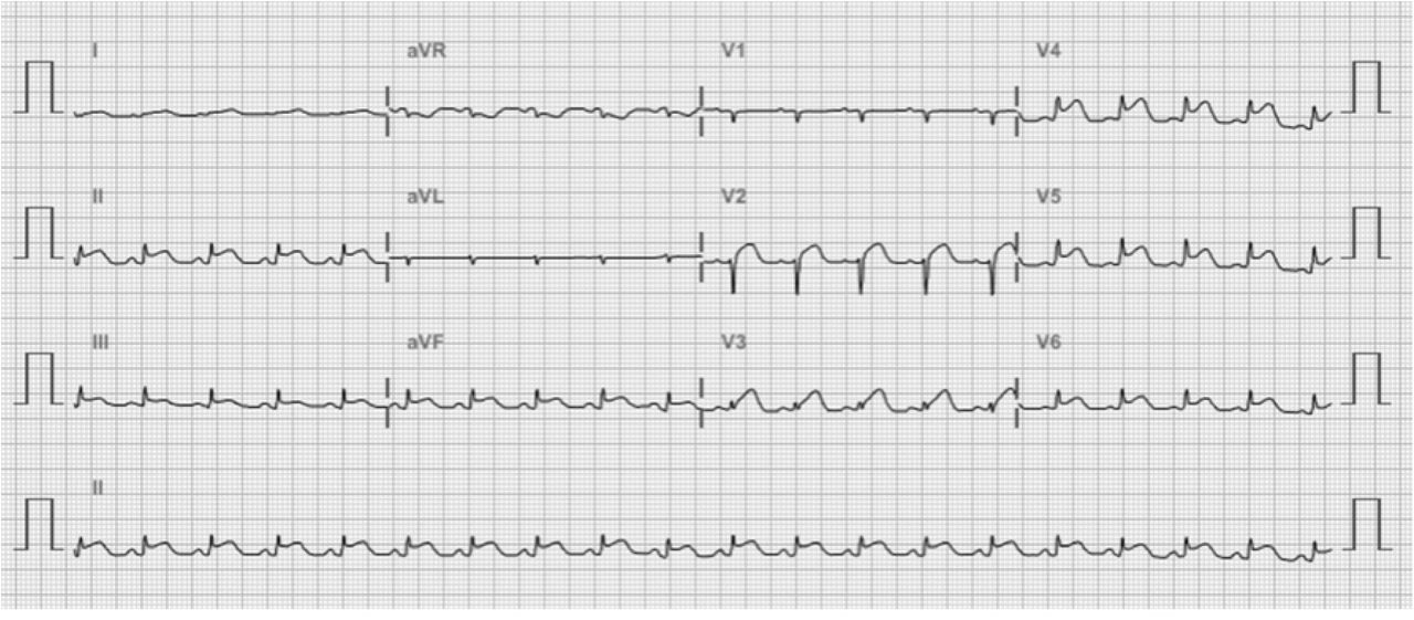 Electrocardiography record from a patient with dengue fever that was dying of myocarditis.The diagnosis of myocarditis was suggested by the diffuse ST-T elevation (case 13 in Table 3).