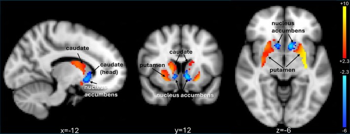 All study (N = 49) group intrinsic connectivity maps (preCue + postCue). The ventral tegmental area is significantly correlated with the putamen and body of the caudate (red‐yellow clusters) and anticorrelated with the nucleus accumbens and head of the caudate (blue to light blue clusters). Images are presented in radiological convention (R = L).