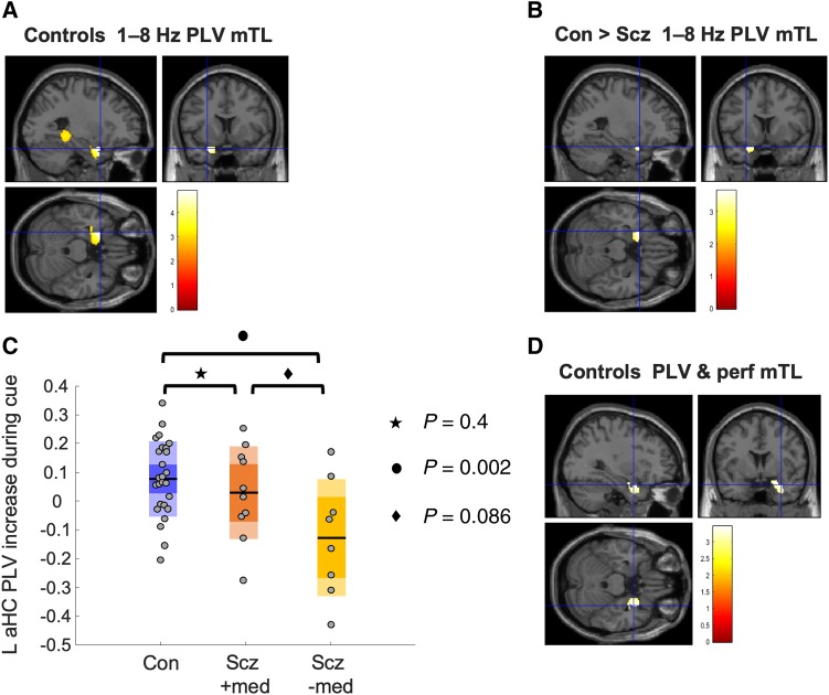 MPFC theta phase coupling analysis. All images are thresholded at Punc < 0.005 for display purposes unless otherwise stated. (A) Controls showed significant increases in 1–8 Hz theta phase coupling (analysed using the PLV) during the cue period in two regions—one in posterior hippocampus [peak (−36 −42 −2), Z = 3.51, PFWE(SVC) = 0.018] and one in anterior mTL [peak (−26 10 −24), Z = 4.07, PFWE(SVC) = 0.003]. Subjects with schizophrenia did not show a significant theta increase in either mTL region. (B) Controls showed greater 1–8 Hz theta PLV than schizophrenia subjects in left anterior mTL, after correcting for trial-by-trial variance in both theta power and head movement and use of antipsychotic medication [peak (−26 10 −22), Z = 3.37, PFWE(SVC) = 0.024]. (C) Eigenvariates (similar to the average) of cue-related PLV increases in the significant region shown in (B) (after theta power regression). The schizophrenia group are divided according to antipsychotic medication use. It is clear that antipsychotics cannot be causing the schizophrenia group’s reduction in PLV as only the schizophrenia group OFF medication show a significant difference in PLV from control subjects (Hedges' g = 1.3, 95% CI 0.4–2.2). The comparison between schizophrenia subjects ON and OFF medication was underpowered and not significant (Hedges' g = 0.8, 95% CI −0.2–1.8). (D) Cue-related theta PLV increase in controls correlated positively with performance in right anterior mTL [peak (32 4 −24), Z = 3.1, PFWE(SVC) = 0.057, Punc = 0.001]. Note: The colour bar scale corresponds to t-statistics in the SPM: here, of beta coefficients resulting from a linear regression of trial-wise performance on PLV on in each voxel.