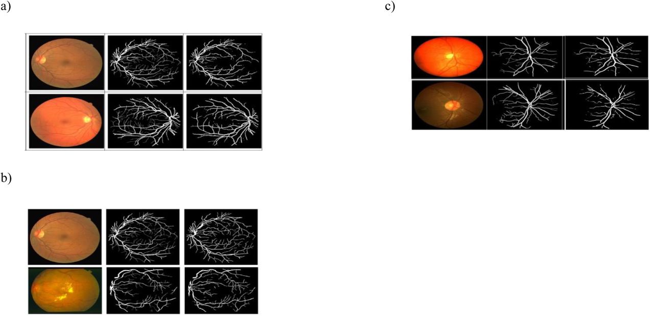 Visualization of the retinal vessel detection results from a) DRIVE dataset b) STARE dataset c) CHASE_DB1 dataset for original, corresponding and detection images.