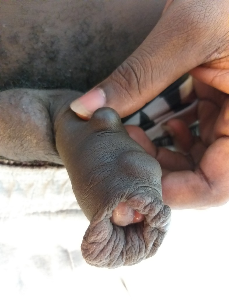 Long-term sequella, 6 months after an infectious paraphimosis following a penile implant insertion (same person than Fig 3).