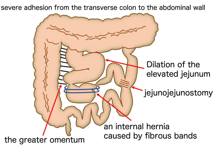 The imaging diagram of the intra-abdominal findings.An internal hernia of the Roux-en-Y limb caused by fibrous bands extending from the greater omentum. The hepaticojejunostomy site is not depicted because of its anatomical location; the jejunum was divided, with the distal limb anastomosed to the hepatic duct and the proximal limb anastomosed to the jejunum (jejunojejunostomy). This illustration was created by the authors and has not been previously published.