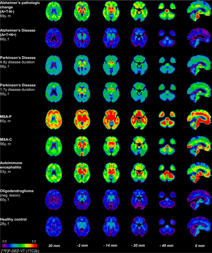 [18F]F-DED PET images in various neurodegenerative diseases. This research was originally published in J Neuroinflammation. Ballweg A, Klaus C, Vogler L, Katzdobler S, Wind K, Zatcepin A, et al. [18F]F-DED PET imaging of reactive astrogliosis in neurodegenerative diseases: preclinical proof of concept and first-in-human data. J Neuroinflammation. 2023;20:68. http://creativecommons.org/licenses/by/4.0/