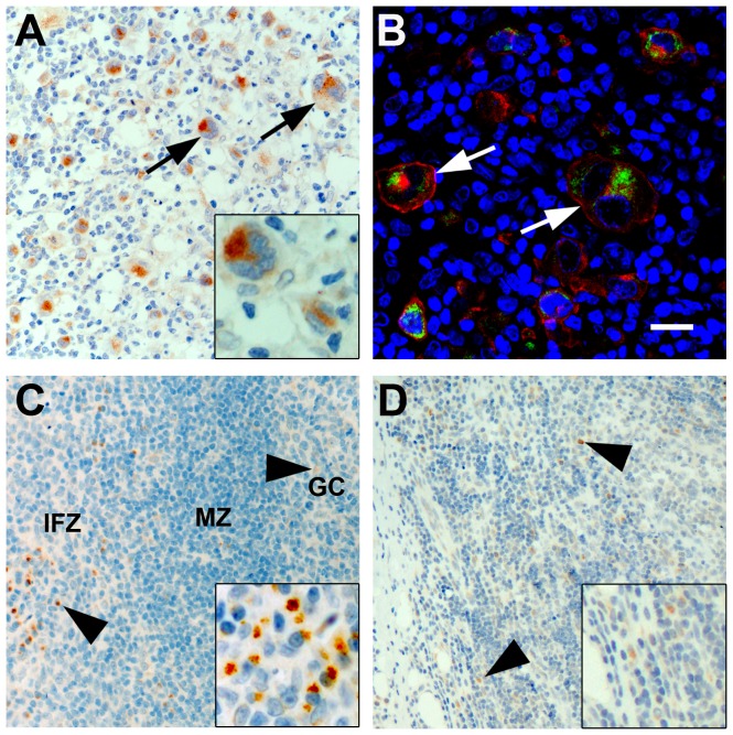 Expression of CB1-receptor in classical Hodgkin lymphoma and reactive non-neoplastic lymphatic tissues.A) Immunohistochemical staining of CB1–N in classical Hodgkin lymphoma showing strong expression of CB1 in HRS cells (arrows). B) Confocal image showing CB1 (green), CD30 (red) and DAPI-stained nuclei (blue) in cHL. Note the CB1 negativity in non-neoplastic infiltrate. C) In a case of reactive tonsillitis, CB1-positive cells (arrow heads) were found in the inter-follicular zone (IFZ) and to a lesser extent in germinal center (GC) and mantle zone (MZ). D) Few disseminated cells were found CB1-positive (arrow heads) in a case of lymphadenitis. Bars = 20 µm.