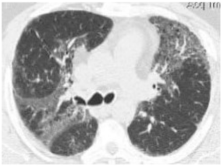 Chest CT of one of the patients with cannabinoid-positive BAL showing bilateral ground-glass opacities (GGO), demarcated by areas of normal lung parenchyma, creating a “mosaic” lung pattern; in the context of the GGO, thickening of the lung interstitium with formation of microcysts can be seen.